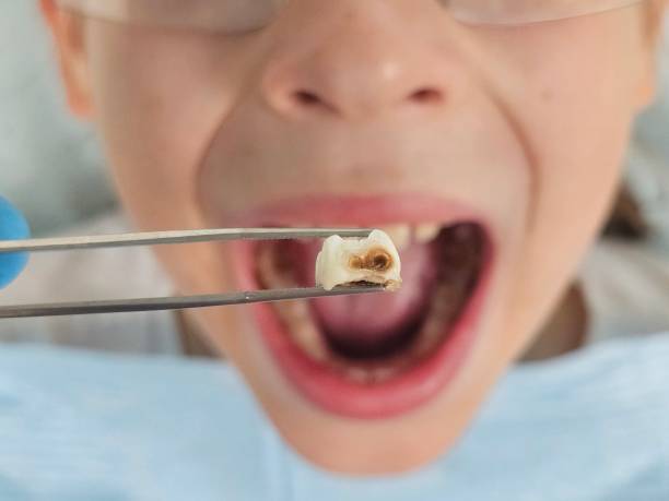 Best Emergency Tooth Extraction in Meggett, SC